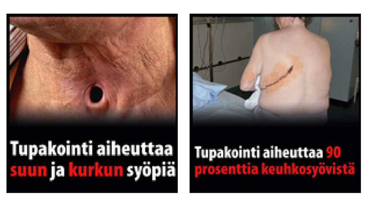 Kaksi tupakka-askiin tulevaa varoituskuvaa. Toisessa näkyy kurkussa oleva reikä lähikuvassa. Toisessa taas näytetään keuhosyöpäleikkauksessa olleen potilaan leikkaushaava.