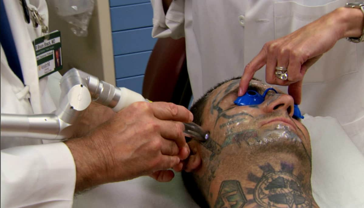 Tatuoinnin poisto tehtiin laseroperaatioilla.