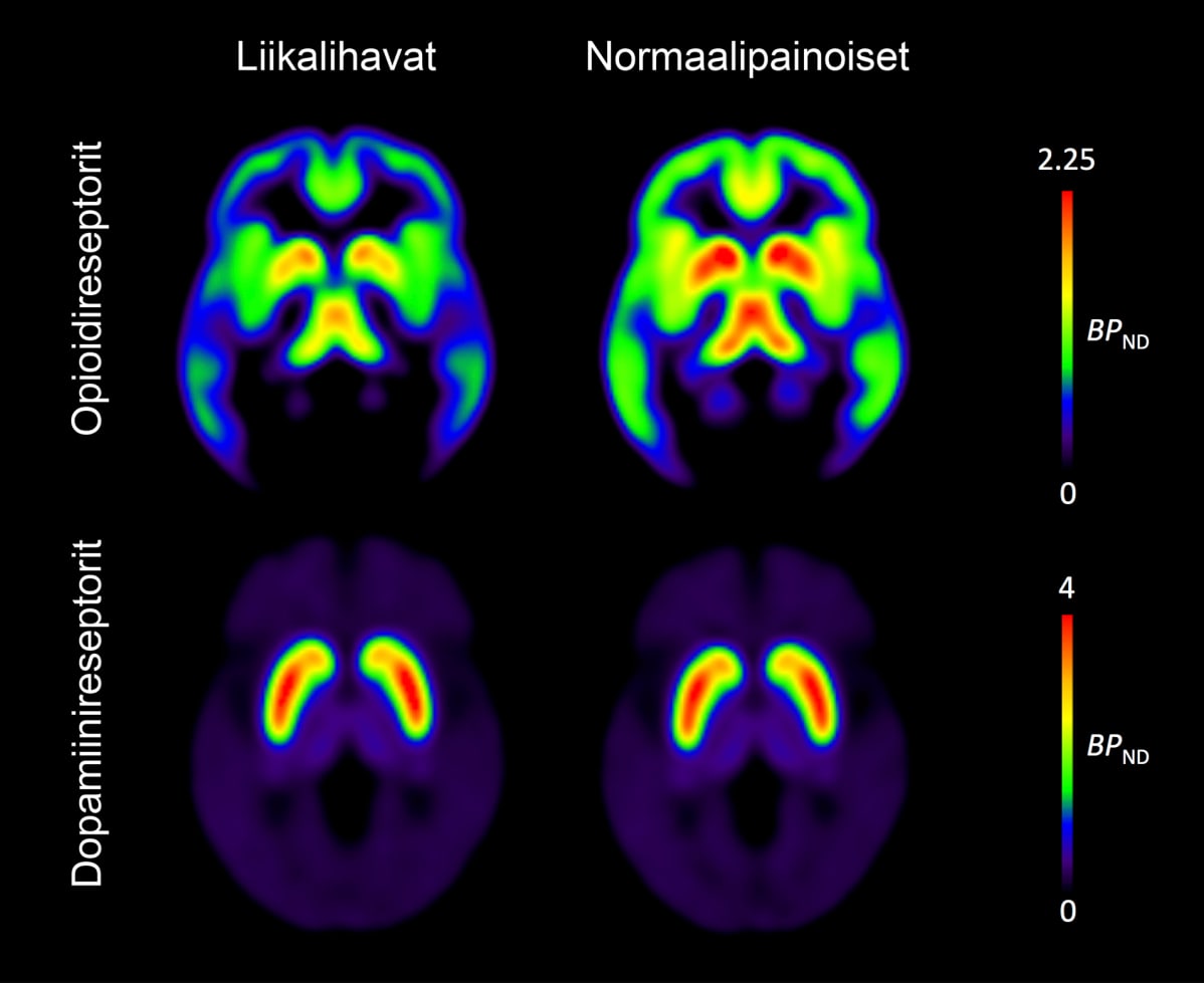 Liikalihavilla aivojen mielihyvää säätelevien opioidireseptorien määrä on madaltunut (ylärivi), mutta miellyttävien asioiden haluamiseen liittyvän dopamiinijärjestelmän toiminnassa ei havaittu muutoksia.