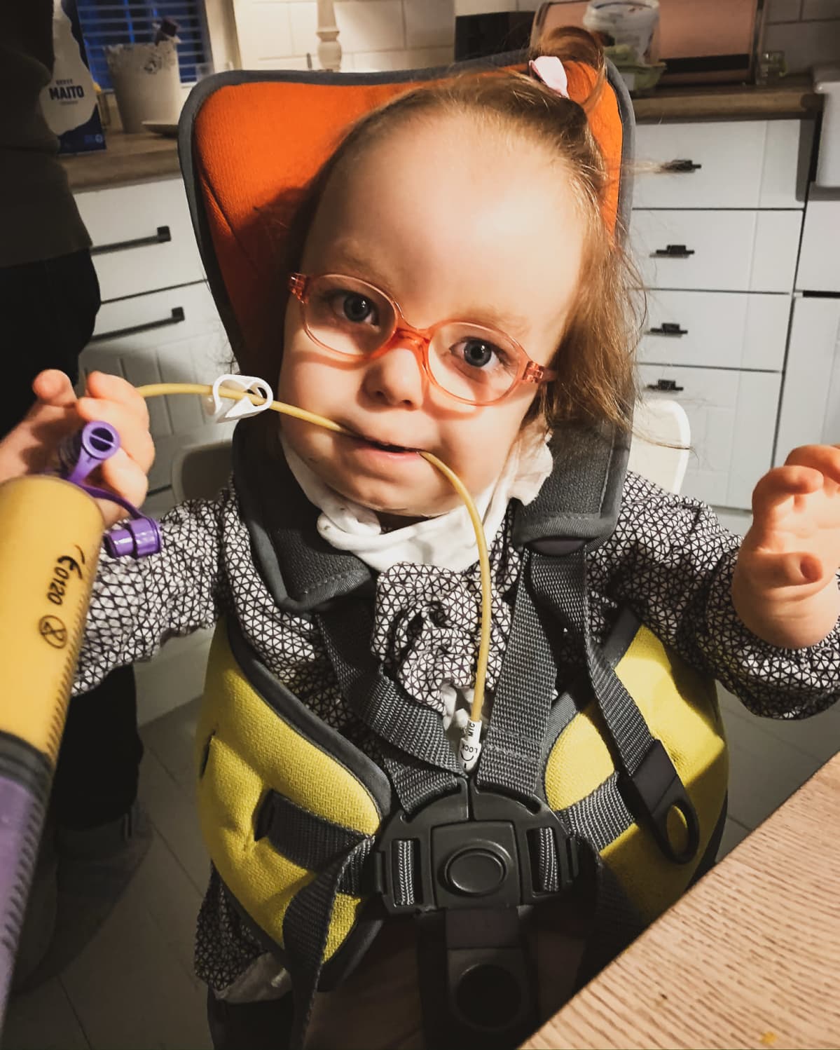 Hilda Tolonen istuu syöttötuolissa ja saa ruokaa PEG-napin kautta
