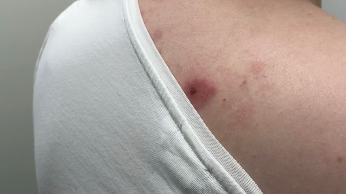 Hyttysenpurema voi nostattaa joillekin hyvinkin isoja ja kutisevia paukamia.