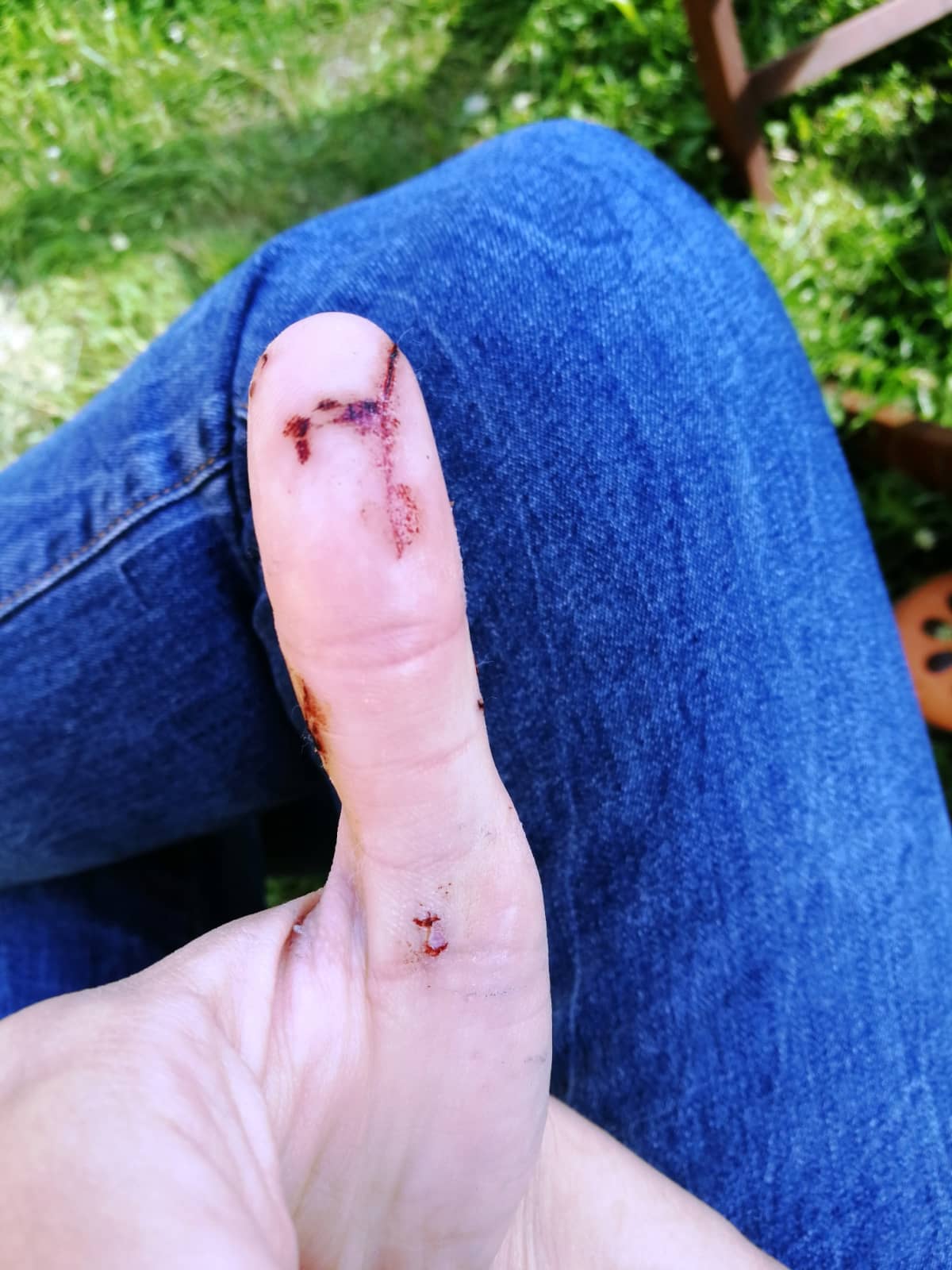 Hauen puremajäljet alkavat parantua peukalossa