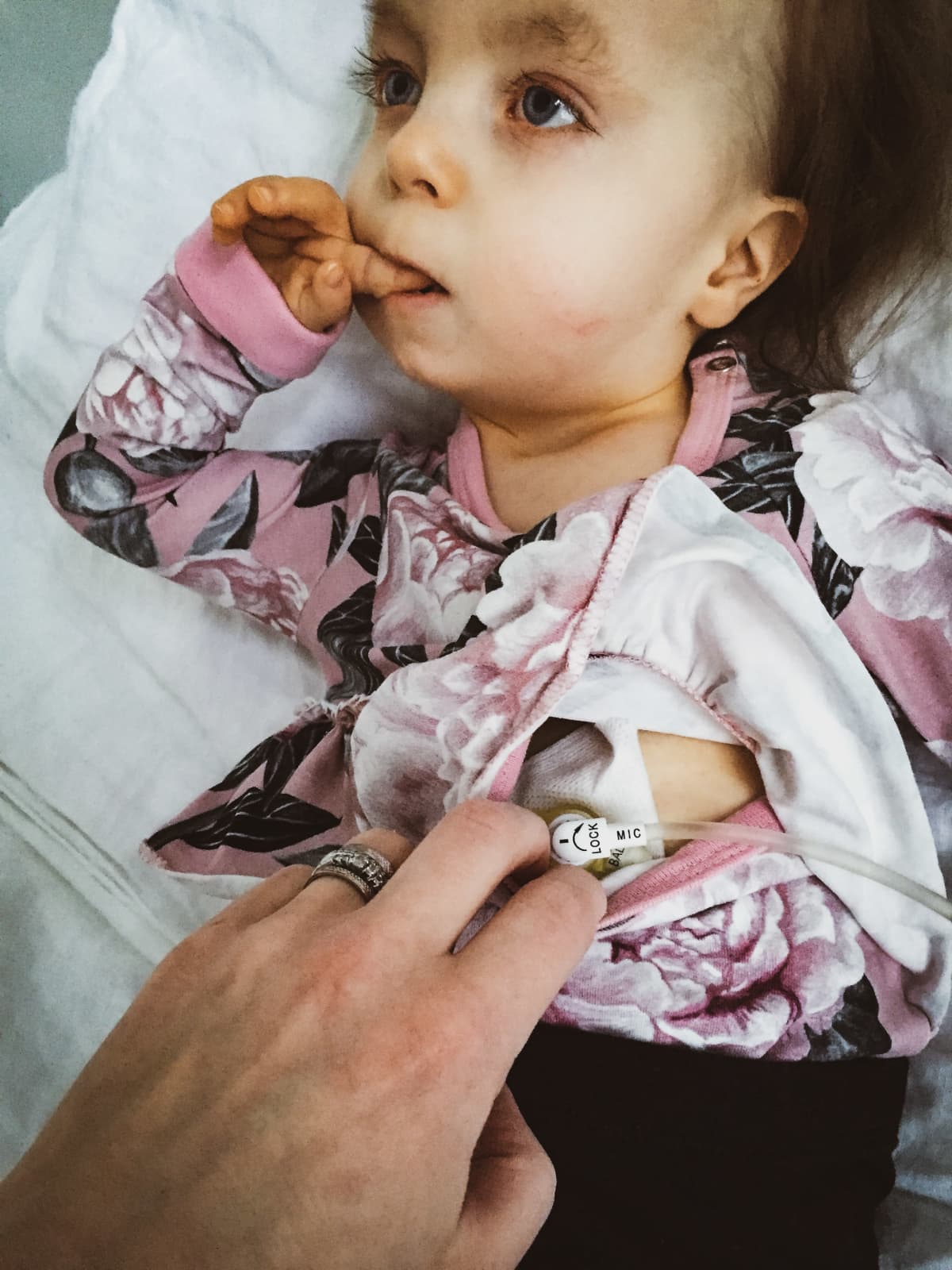 Hilda Tolosen vatsaan on kiinnitetty pegnappi, johon ruiskutetaan ruokaa letkun kautta.
