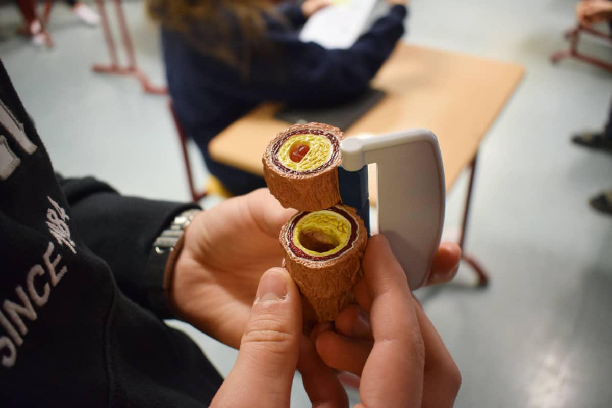 Pienoismalli tukkeutuneesta verisuonesta.