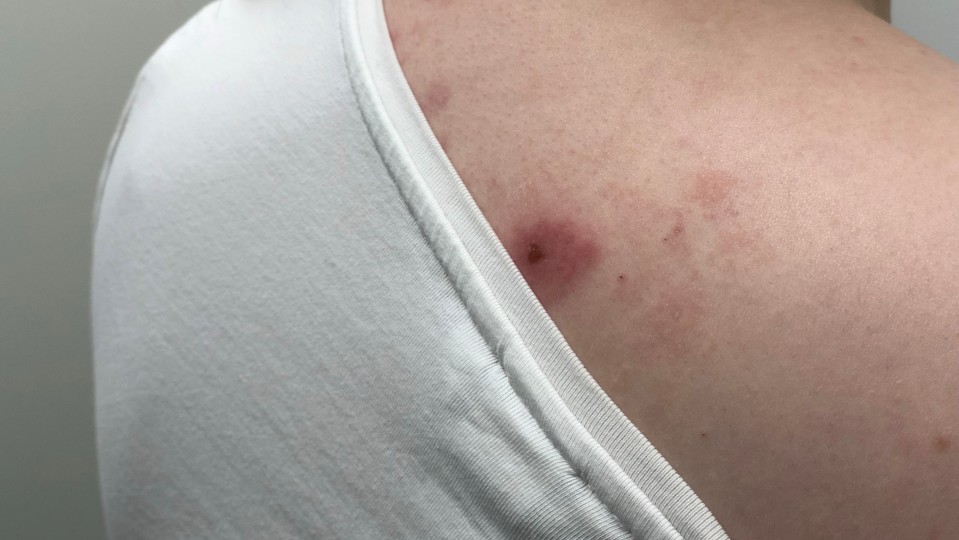 Hyttysenpurema voi nostattaa joillekin hyvinkin isoja ja kutisevia paukamia.