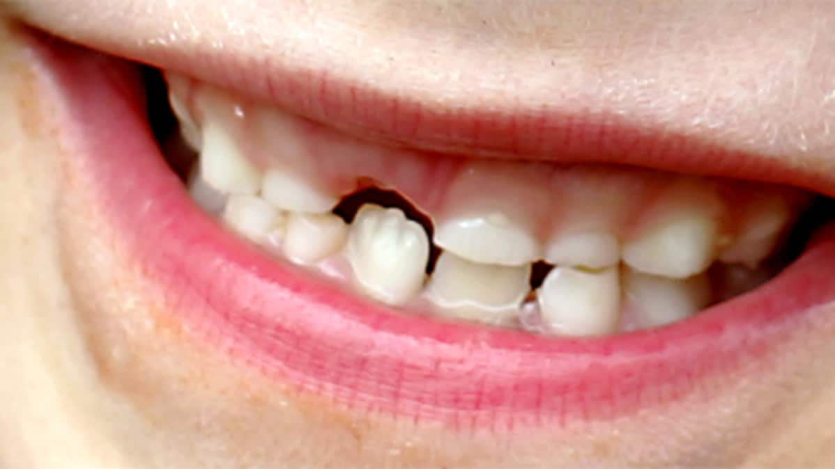 hampaiden eroosio