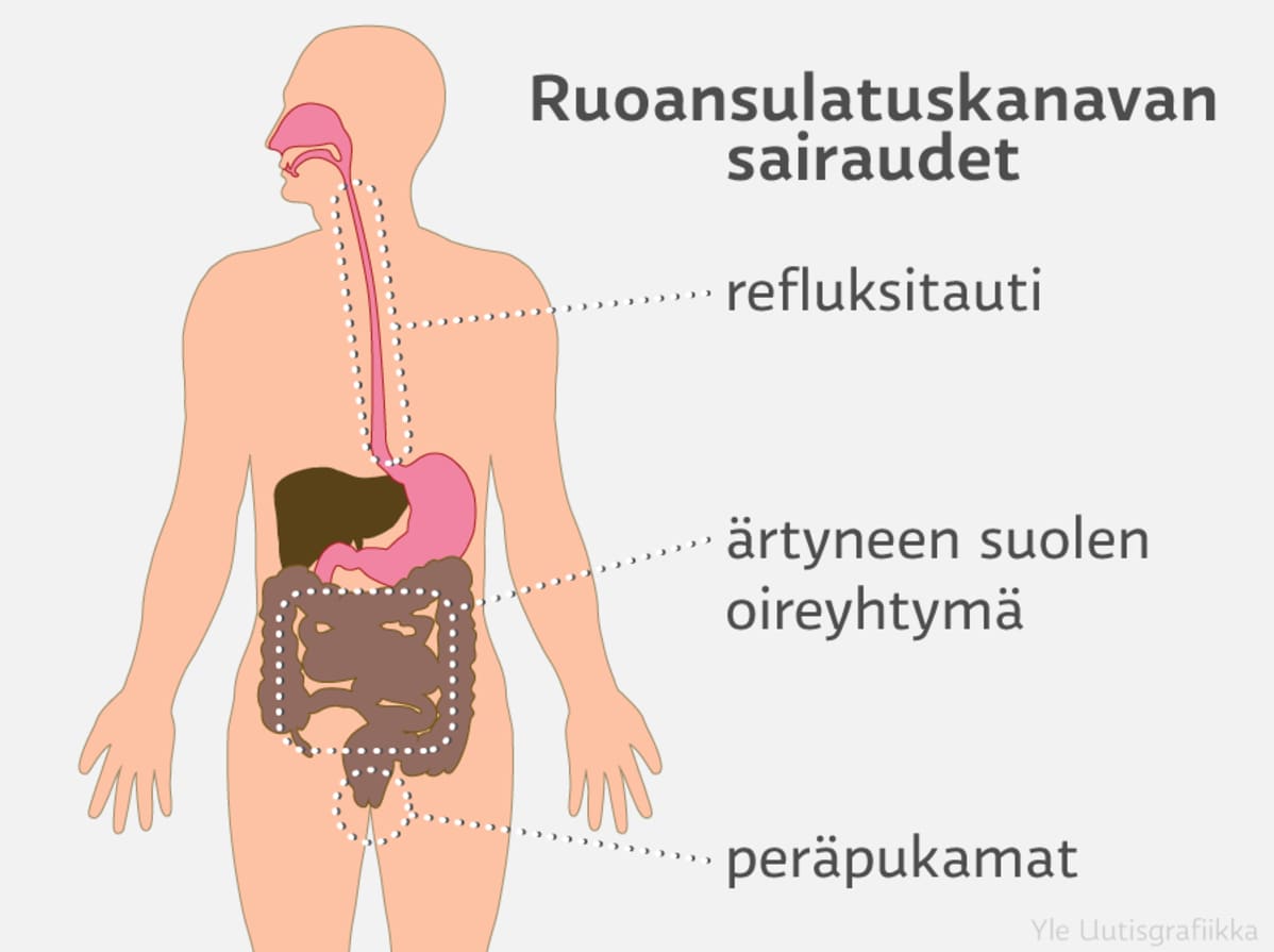 ruoansulatuskanavan sairaudet