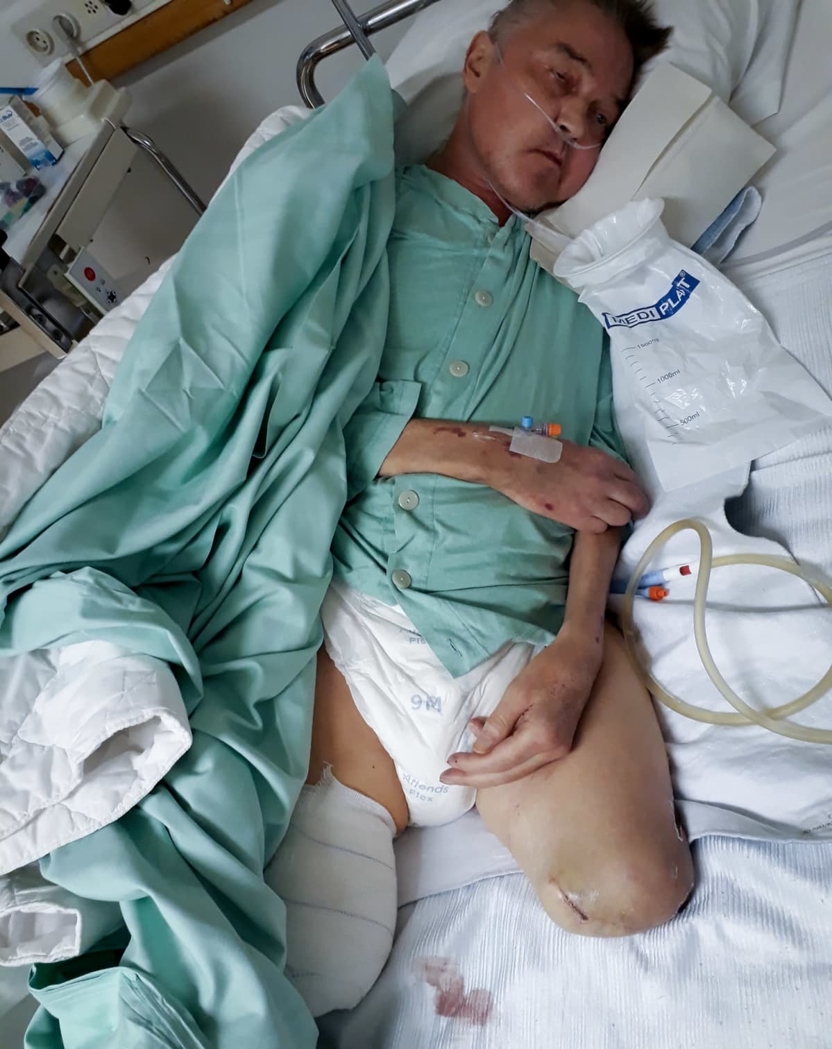 Tumppi Partanen sairaalasängyssä jalat amputoituna