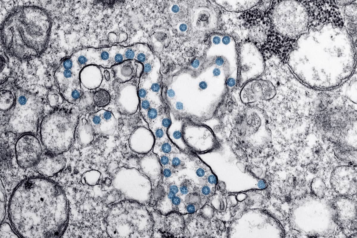 SARS-CoV-2-viruksia potilaan kudoksissa siniseksi väritettyinä.