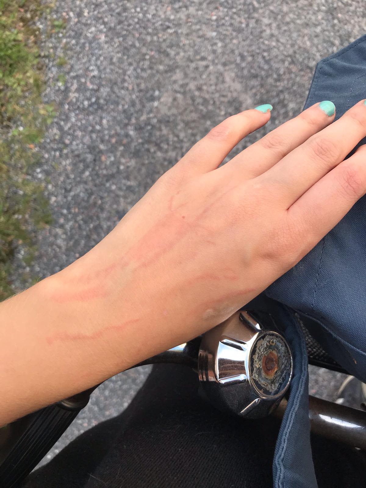 Kuva päiväkotityöntekijän saamasta vammasta.