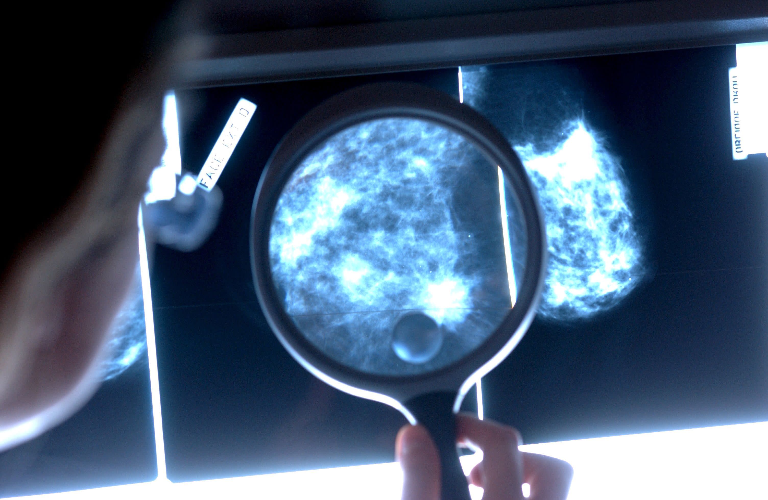 قالت دراسة فنلندية إن الأنسجة الدهنية السليمة يمكن أن تمنع انتشار سرطان الثدي