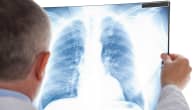 lääkäri tutkii röntgenkuvaa keuhkoista
