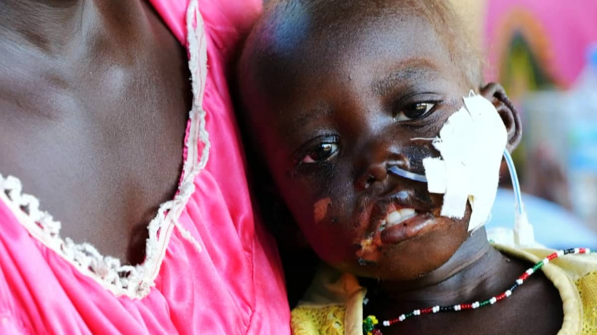 Kuvassa on nälkiintyvä pieni lapsi Etelä-Sudanissa.