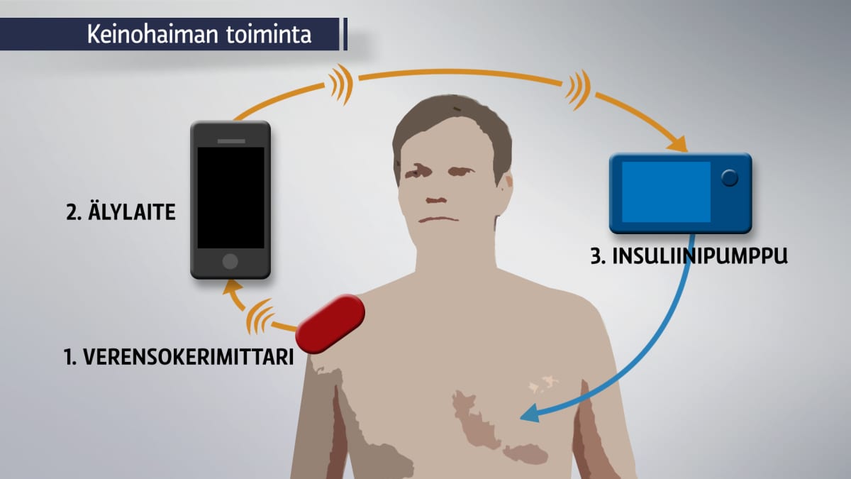 Havainnekuva keinohaiman toiminnasta.