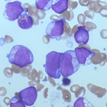 Tiedeykkönen: Ärhäkkä leukemia kuriin yksilöllisellä lääketieteellä