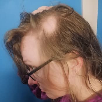 Alopecia nousi puheenaiheeksi kohutun Oscar-gaalan jälkeen – myös Sari Pöyhöselle sairaus kuuluu arkeen