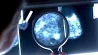 A magnifying glass on top of breast cancer tissue on a backlit screen