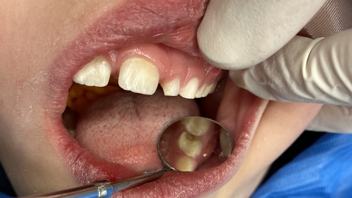 tandläkare petar med verktyg i munnen på ung patient.