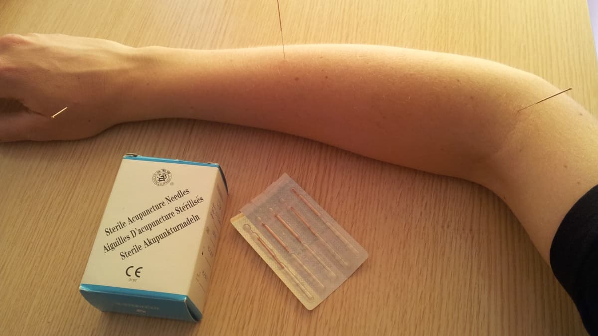 akupunkturnålar på en arm