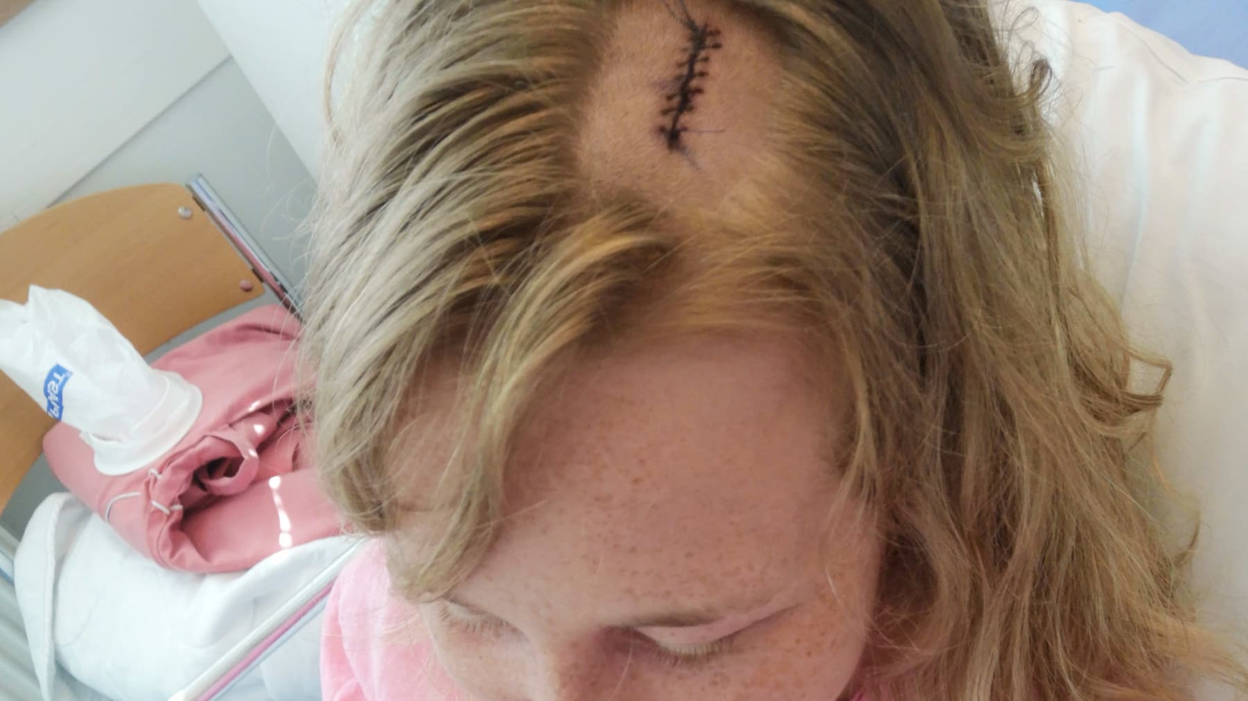 Ringettepelaaja Katariina Kurikon päässä olevat tikit aivoleikkauksen jälkeen.
