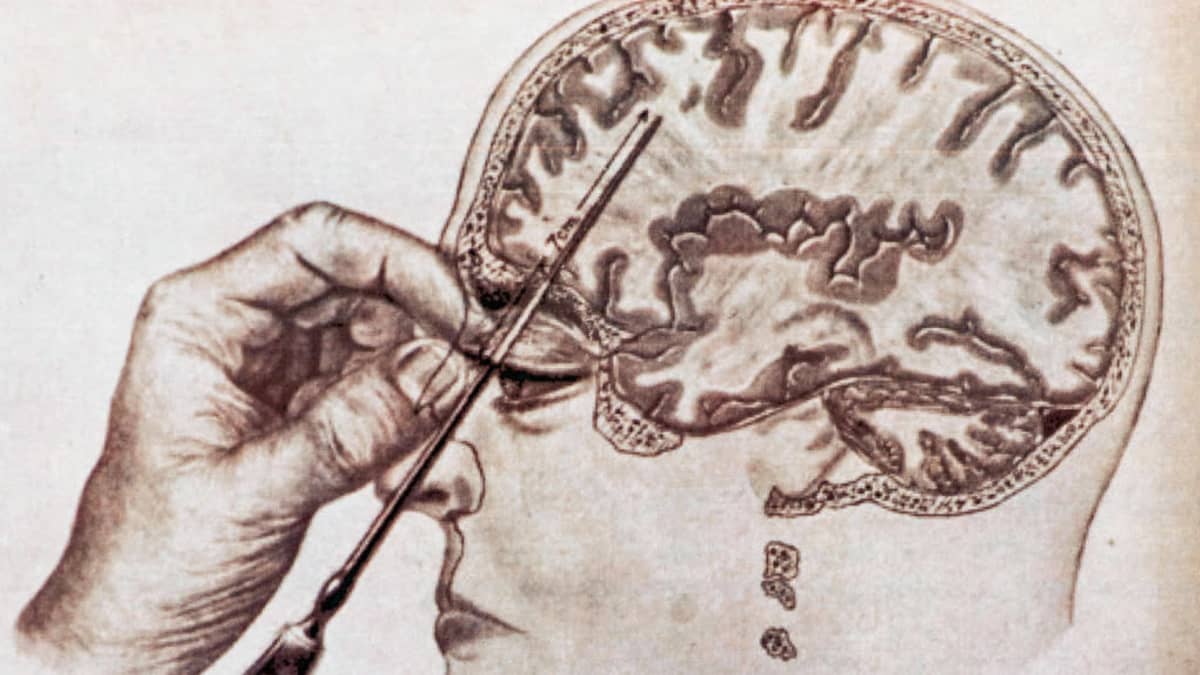 Piirrokuva pään pään ja aivojen poikkileikkauksesta, jossa on työnnettu jääpiikki silmän läpiaivojen otsalohkoon.