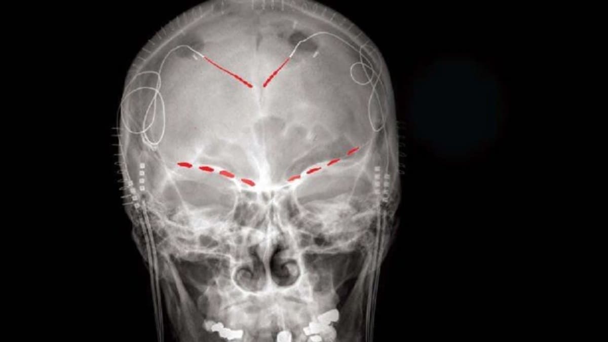 Röntgenkuva, jossa näkyy ihmisen kallo ja hartiat, aivoihin asennetut elektrodit sekä niiden ohjauslaitteet solisluiden päällä.