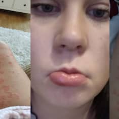 Hanna Koivulahden kasvot nokkosihottuman turvottamina