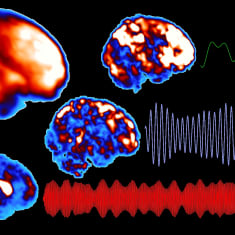 Magnettikuvauksen avulla otettuja kuvia ihmisen aivoista.