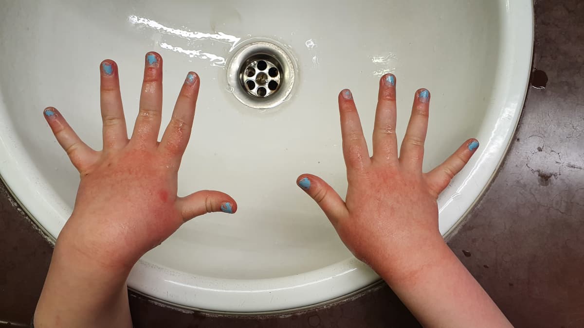 Lapsen märät kädet, joiden iho punertaa käsien pesun jälkeen lavuaarin yläpuolella.
