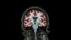 Tietokonetomografiakuva aivoista