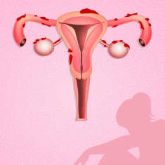 Piirretty kuva kohdusta ja endometrioosista
