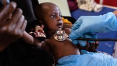 Lähikuva pienestä laihasta somalialaisesta vauvasta, jonka rintakehää lääkäri kuuntelee stetoskoopilla aliravitsemusklinikalla