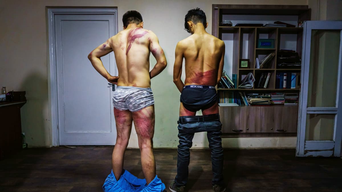 Kaksi pahoinpideltyä toimittajaa esittävät vammojaan takaapäin katsottuna.