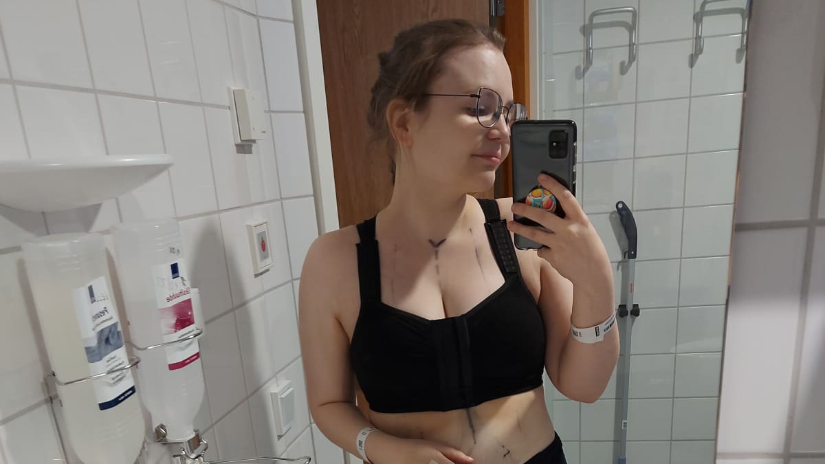 Iina Marttila ottaa selfieta sairaalan vessassa. Päällään hänellä on alusvaatteet. Iholla näkyy plastiikkakirurgin piirtämiä leikkausviivoja.