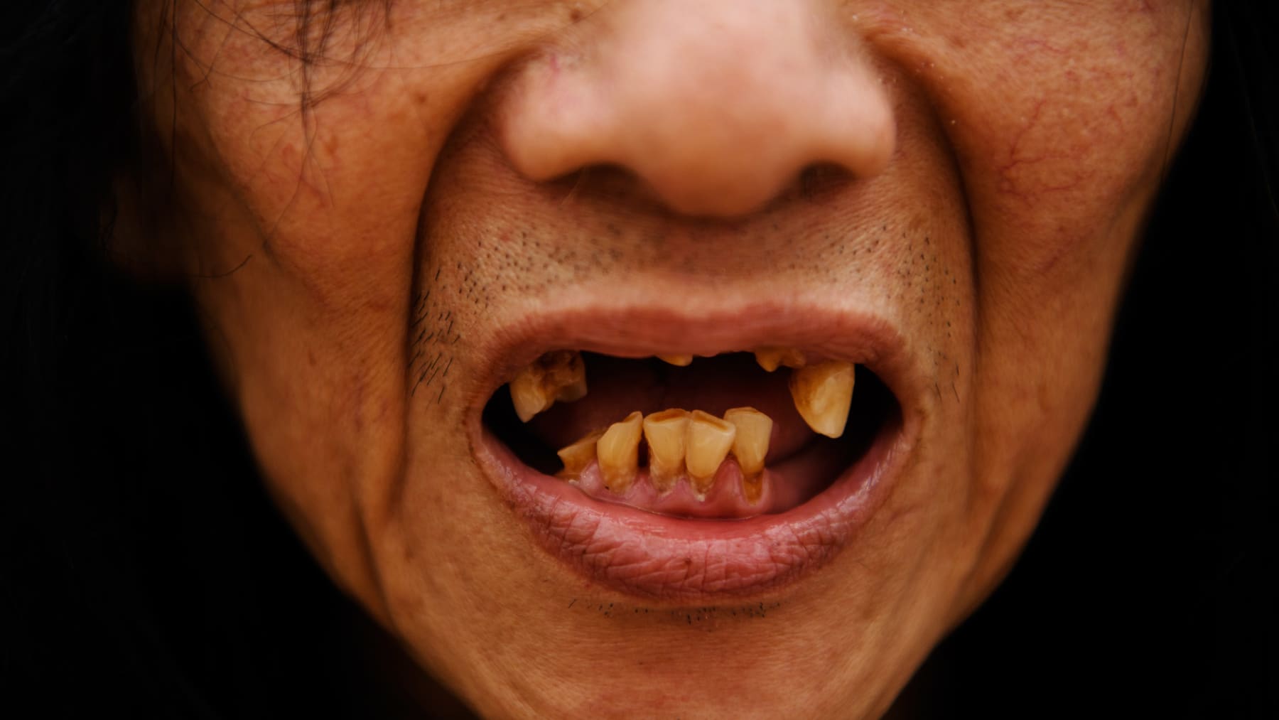 Huumeita käyttävän ihmisen huonokuntoiset hampaat.