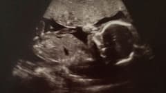 Ultraljudsbild på ett foster. 