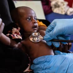 Lähikuva pienestä laihasta somalialaisesta vauvasta, jonka rintakehää lääkäri kuuntelee stetoskoopilla aliravitsemusklinikalla