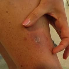 Borrelioosin aiheuttama ihomuutos sääressä.