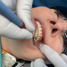 Hammasimplantti valmiiksi asennettuna potilaan suussa.