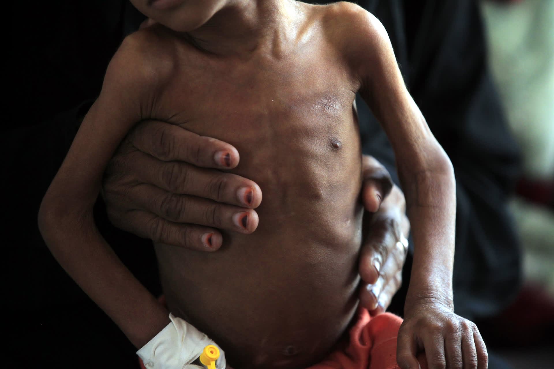 Äiti kannattelee aliravittua lastaan sanaalaisessa sairaalassa Jemenissä lokakuun alussa.