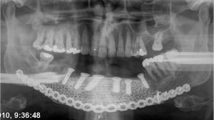 Potilaan alaleuan kasvain on poistettu ja korvattu ei-yksilöllisellä implantilla. Myöhemmin luun kasvettua siihen voidaan istuttaa hammasimplantit.