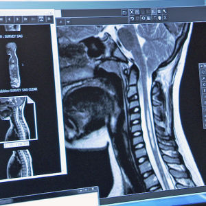 Chiari-potilaan röntgenkuva