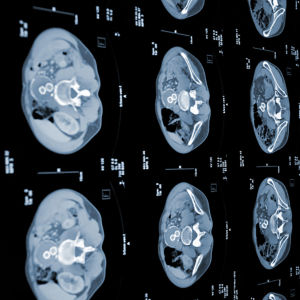 Flera röntgenbilder på hjärnan.