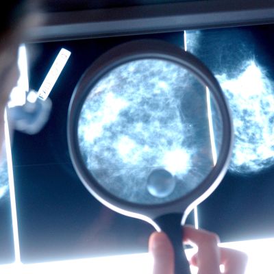 Lääkäri tutkii syöpäkasvainta mammografiakuvasta.