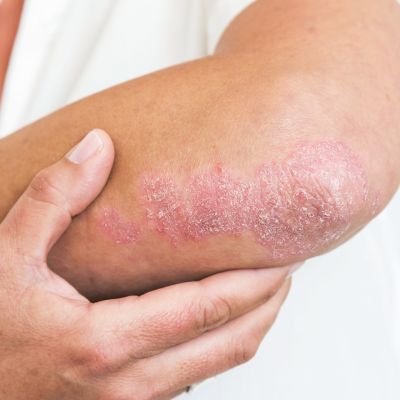 Psoriaasiksen aiheuttamaa ihomuutosta kyynärpään alueella.