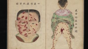 Illustrationer i japansk text från 1700-talet av smittkoppor Japanska illustrationer från 1700-talet av smittkoppor