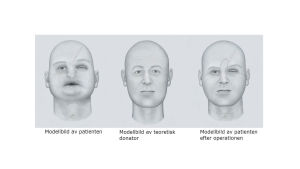 Modellbild av Nordens första ansiktstransplantation som gjordes i Finland ifjol. Modellbild av Nordens första ansiktstransplantation vid HNS