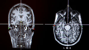 Kaksi röntgenkuvaa aivoista.