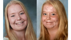 Hanna Saarijärvi är tacksam över att hon till sist hittade rätt hudspecialist. Två bilder (skolfoton) av Hanna Saarijärvi. På det ena ler hon med öppen mun och har ganska slät hud. På det andra ler hon bara lite grann med stängd mun och har akne i ansiktet.