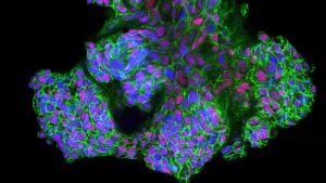 Potilaan rintasyövästä eristettyjä kudosviljelmiä hyödynnetään rintasyöpätutkimuksessa. Vihreä väri merkitsee syöpäsoluja, ja violetti väri solujen tumaa jossa MYC syöpägeeni on aktiivinen.
